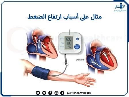 مثال على أسباب ارتفاع الضغط