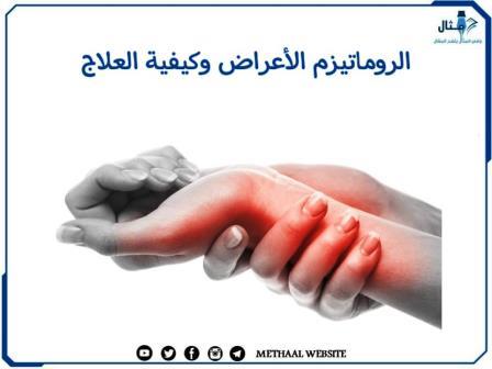 الروماتيزم الأعراض وكيفية العلاج الروماتيزم الأعراض وكيفية العلاج