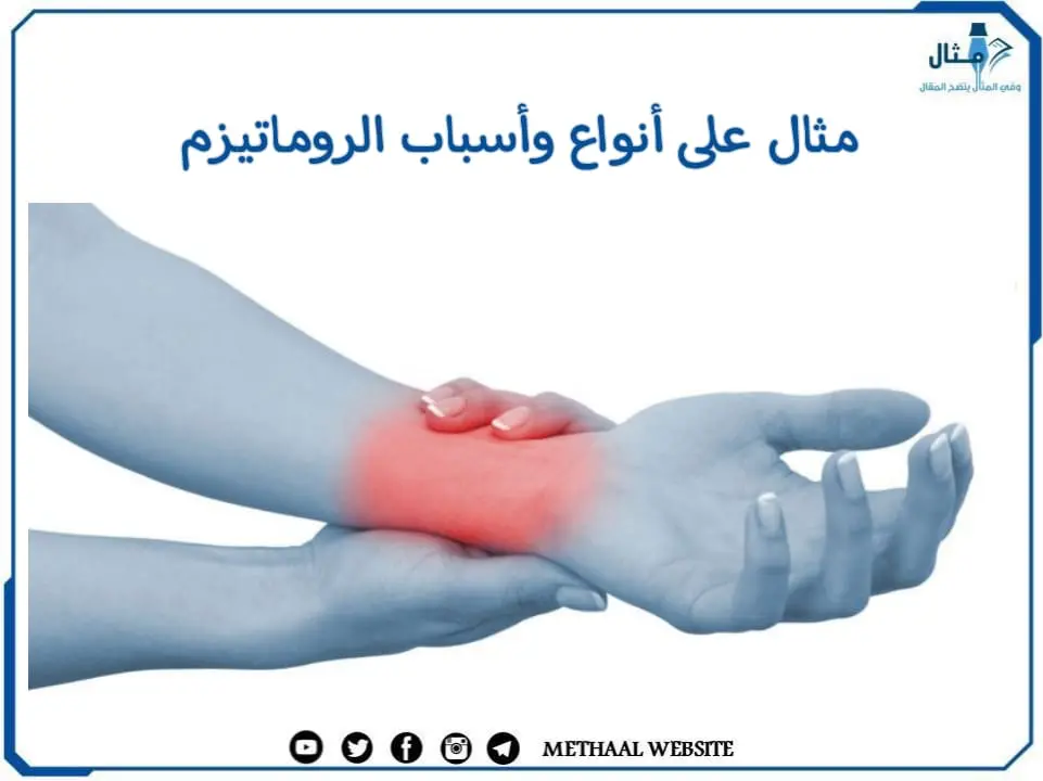مثال على أنواع وأسباب الروماتيزم مثال على أنواع وأسباب الروماتيزم