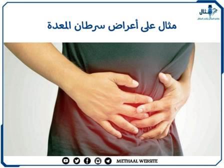 مثال على أعراض سرطان المعدة