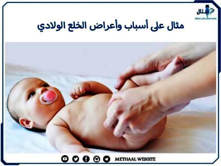 مثال على أسباب وأعراض الخلع الولادي مثال على أسباب وأعراض الخلع الولادي