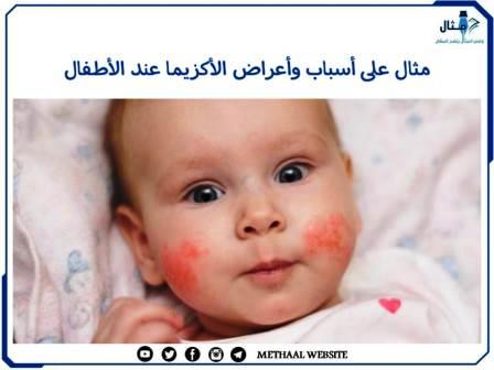 مثال على أسباب وأعراض الأكزيما عند الأطفال مثال على أسباب وأعراض الأكزيما عند الأطفال