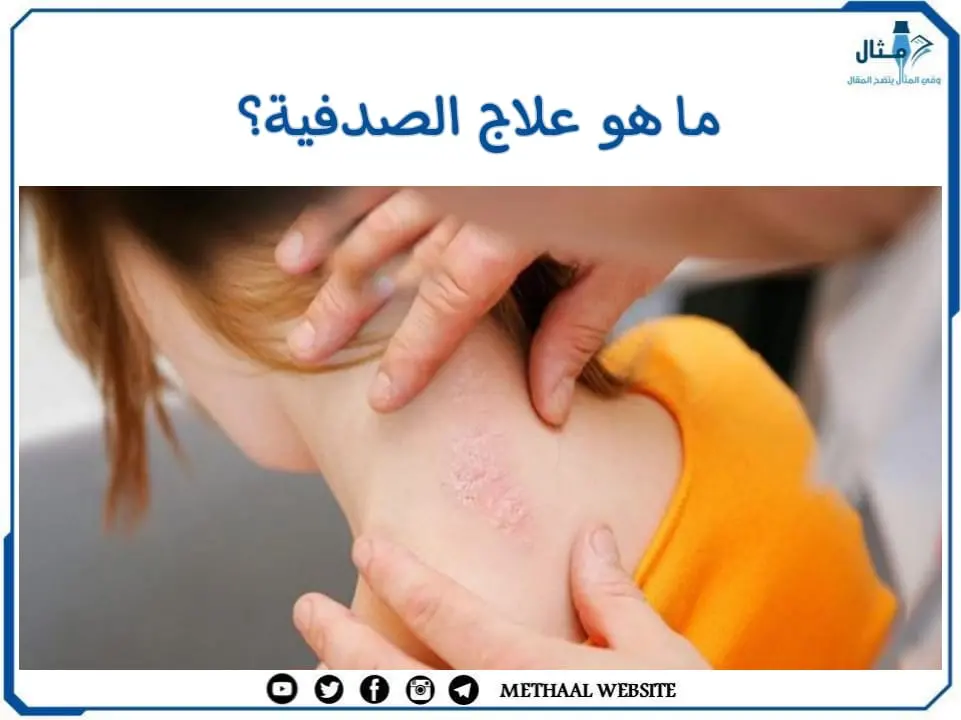 ما هو علاج الصدفية؟