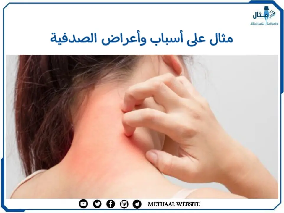 مثال على أسباب وأعراض الصدفية مثال على أسباب وأعراض الصدفية