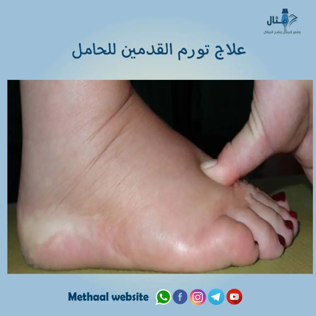 علاج تورم القدمين للحامل علاج تورم القدمين للحامل
