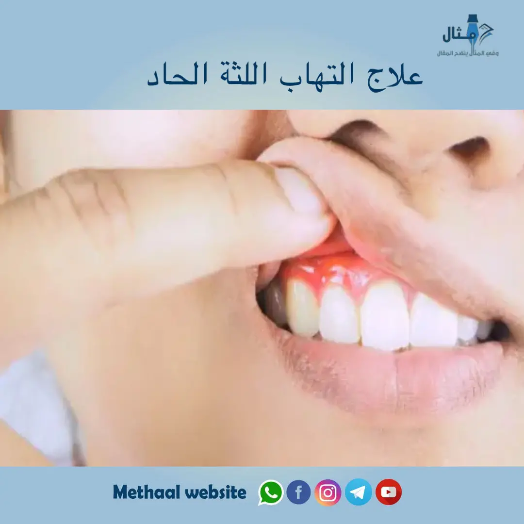 علاج التهاب اللثة الحاد علاج التهاب اللثة الحاد
