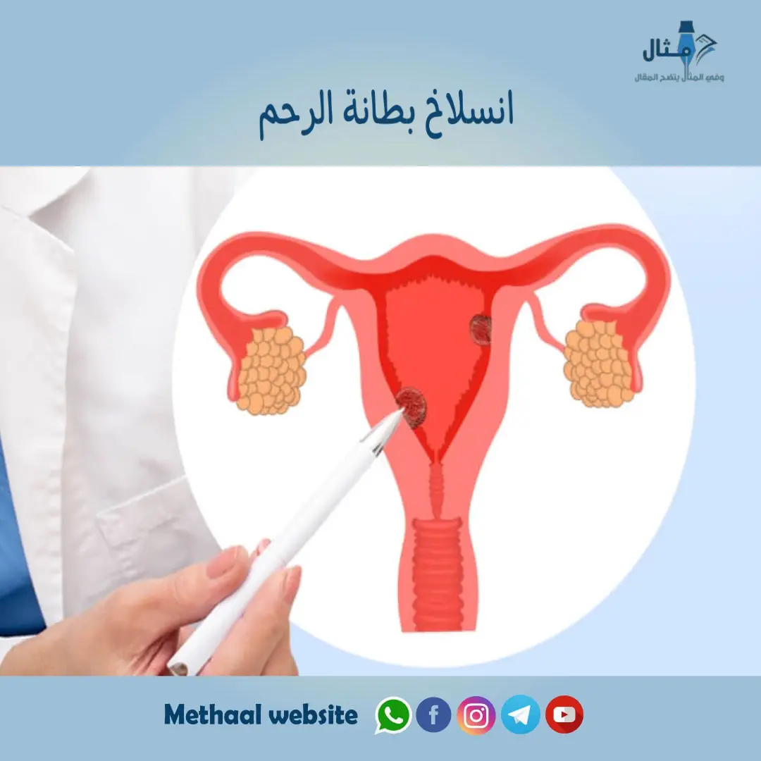انسلاخ بطانة الرحم انسلاخ بطانة الرحم