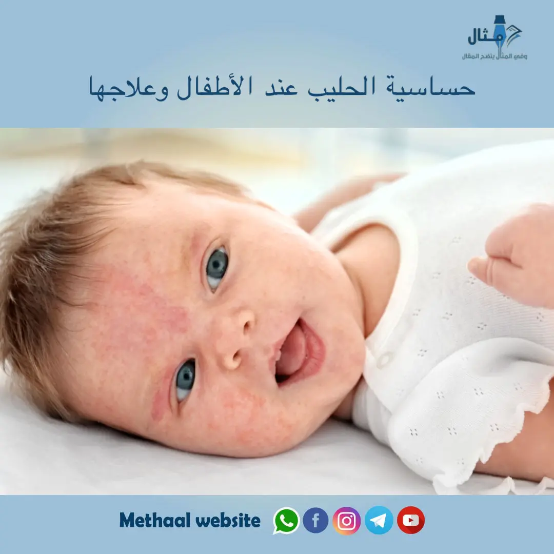 حساسية الحليب عند الأطفال وعلاجها حساسية الحليب عند الأطفال وعلاجها