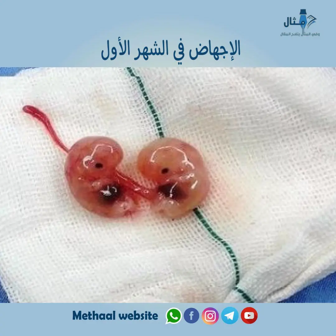الإجهاض في الشهر الأول الإجهاض في الشهر الأول