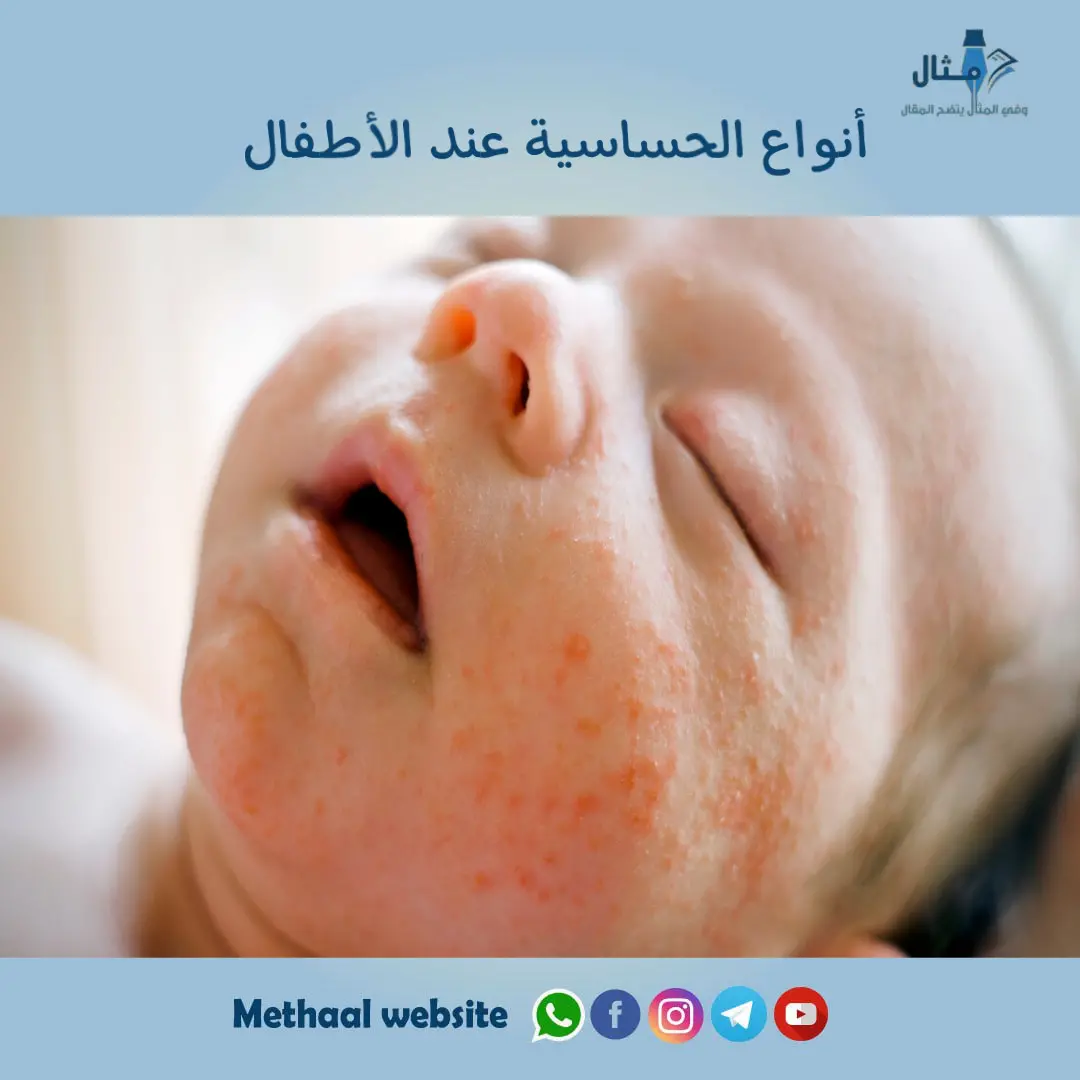 أنواع الحساسية عند الأطفال أنواع الحساسية عند الأطفال