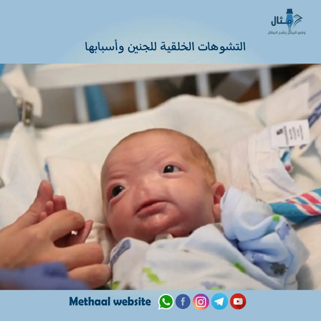 التشوهات الخلقية للجنين وأسبابها التشوهات الخلقية للجنين وأسبابها