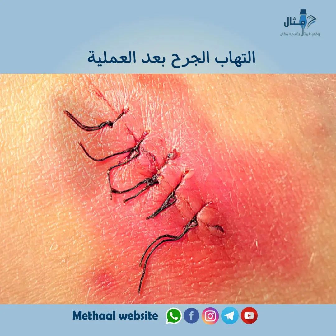 التهاب الجرح بعد العملية التهاب الجرح بعد العملية