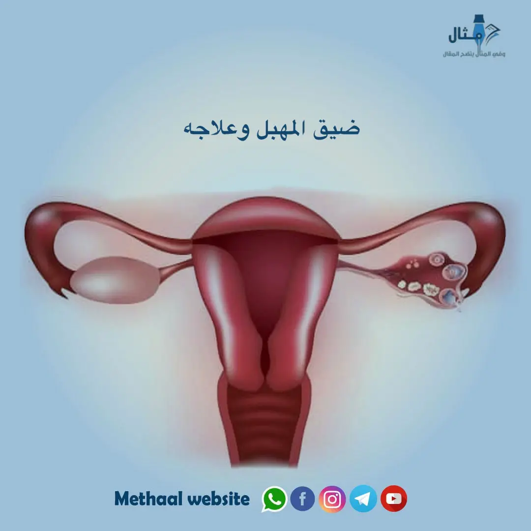 ضيق المهبل وعلاجه