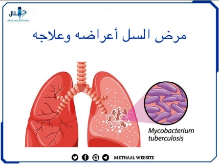 مرض السل، أعراضه وعلاجه