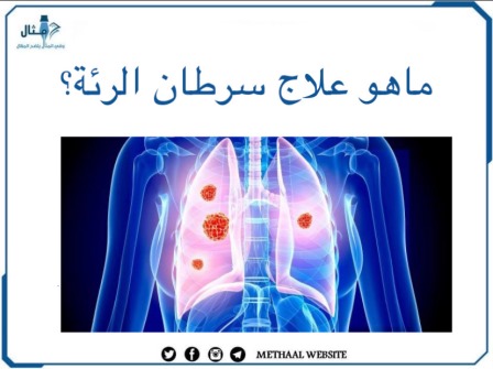 ما هو علاج سرطان الرئة؟