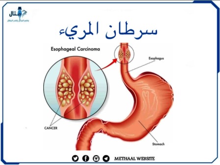 سرطان المريء