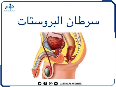 سرطان البروستات