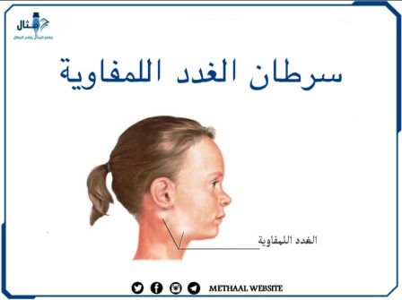 سرطان الغدد اللمفاوية