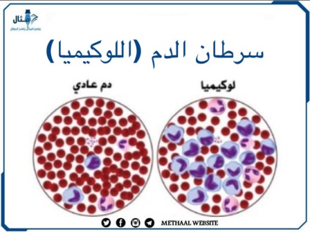 سرطان الدم ( اللوكيميا) 