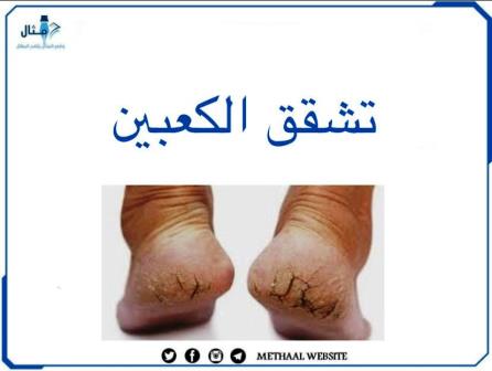 تشقق الكعبين أسبابها وطرق علاجها تشقق الكعبين أسبابها وطرق علاجها