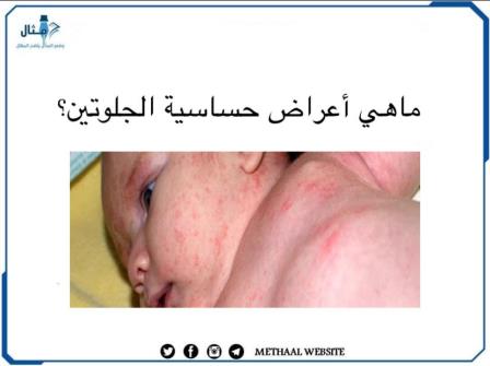 ما هي أعراض حساسية الجلوتين؟ ما هي أعراض حساسية الجلوتين؟