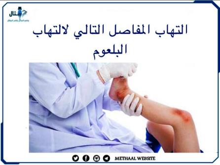 التهاب المفاصل التالي لالتهاب البلعوم التهاب المفاصل التالي لالتهاب البلعوم