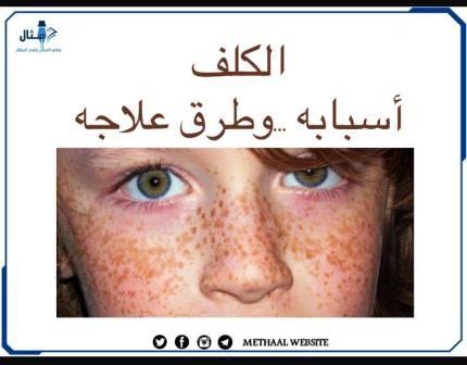 الكلف أسبابه وطرق علاجه الكلف أسبابه وطرق علاجه