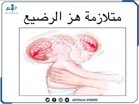 متلازمة هز الرضيع