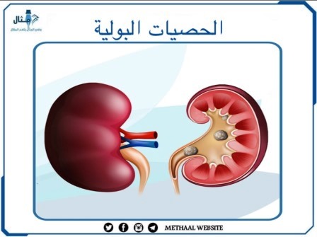 الحصيات البولية، الأسباب والأعراض وطرق التشخيص والعلاج