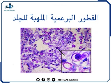 الفطور البرعمية الملهبة للجلد