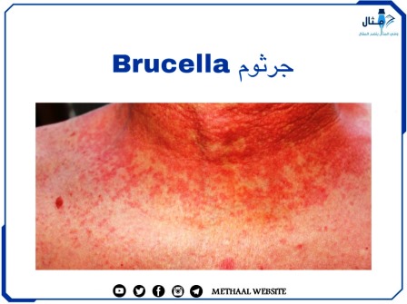 جرثوم ال Brucella