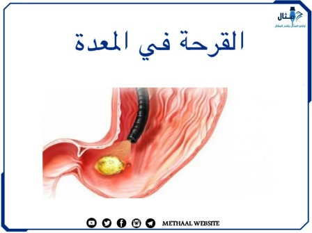 القرحة في المعدة