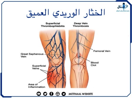 الخثار الوريدي العميق