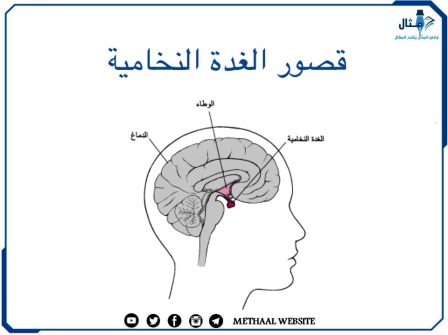 قصور الغدة النخامية