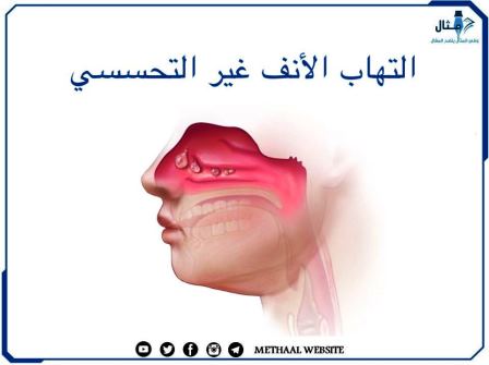 التهاب الأنف غير التحسسي التهاب الأنف غير التحسسي