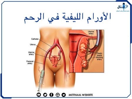 الأورام الليفية في الرحم