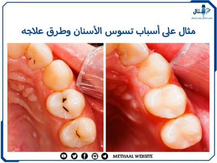 مثال على أسباب تسوس الأسنان وطرق علاجه