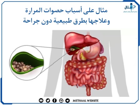 مثال على أسباب حصوات المرارة وعلاجها بطرق طبيعية دون جراحة