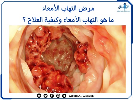 مرض التهاب الأمعاء، ما هو التهاب الأمعاء وكيفية العلاج