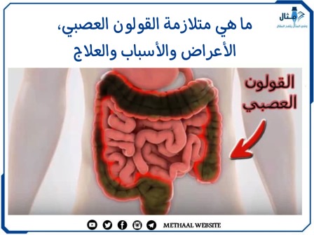 ما هي متلازمة القولون العصبي، الأعراض والأسباب والعلاج