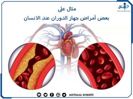 مثال على بعض أمراض جهاز الدوران عند الانسان