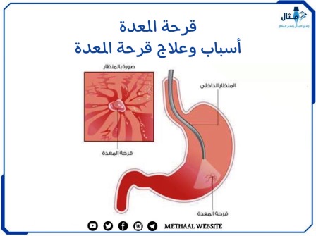 قرحة المعدة ، أسباب وعلاج قرحة المعدة