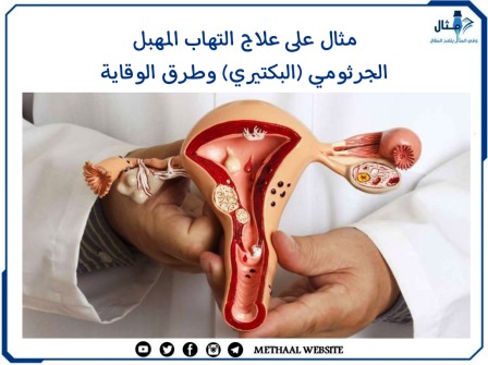 مثال على علاج التهاب المهبل الجرثومي (البكتيري) وطرق الوقاية