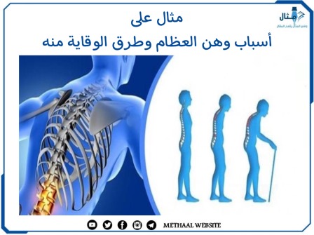 مثال على أسباب وهن العظام وطرق الوقاية منه