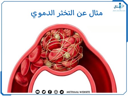 مثال على التخثر الدموي