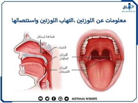 معلومات عن اللوزتين ، التهاب اللوزتين واستئصالها