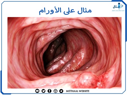 مثال على الأورام