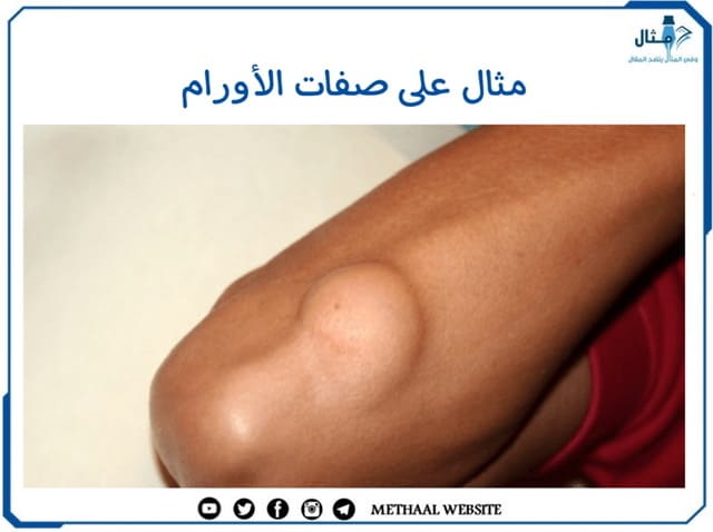 مثال على صفات الأورام مثال على صفات الأورام