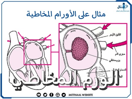 مثال على الأورام المخاطية