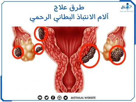 طرق علاج آلام الانتباذ البطاني الرحمي